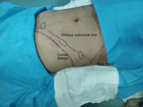 Figure 10 Direction of hydrodisscetion in oblique subcostal block. Initially subcostal TAP block is performed, then the needle moved along the oblique subcostal line.
