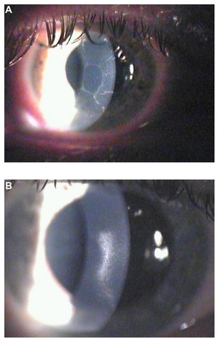 Figure 1 Biomicroscopic image of the right eye of a 31-year-old female patient with type 1 diabetes. (A) One week after myopic photorefractive keratectomy. The central cornea presents a large area of de-epithelialization. (B) Six months after photorefractive keratectomy. The re-epithelialization is complete but is present as a dense linear central scar. (C) One year after photorefractive keratectomy. The linear central scar is considerably reduced but is still visible.
