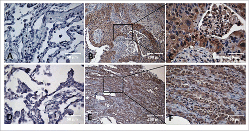 Figure 1. Immunohistochemical staining of MDM2, c-Myc in Lung cancer tissue and adjacent normal tissue slides. Tissue slides were stained with monoclonal anti-MDM2 antibody (A, B, C) and anti-c-Myc antibody (D, E, F), respectively. (A) Negative stain pattern of MDM2 in representative adjacent normal tissue (×400 magnification). (B and C) Positive stain pattern of MDM2 in representative lung cancer tissue (×100 and ×400 magnification). (D) Negative stain pattern of c-Myc in representative adjacent normal tissue (×400 magnification). (E and F) Positive stain pattern of c-Myc in representative lung cancer tissue (×100 and ×400 magnification).