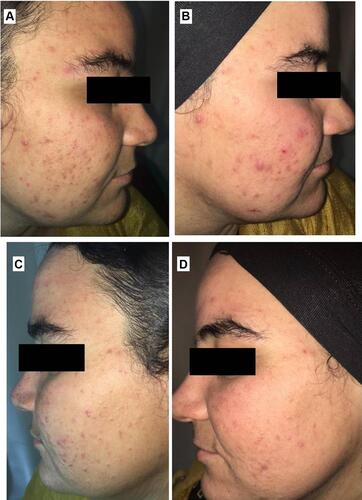 Figure 11 Right side of face before (A) and after topical tretinoin (B). Left side of the face before (C) and after ethosomal RP hydrogel (D). Moderate erythema noted after topical tretinoin.