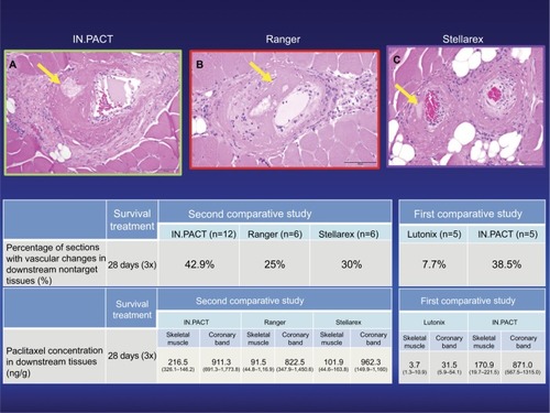 Figure 2 Representative images of downstream nontarget skeletal muscle and coronary band tissues from healthy swine after treatment of femoral arteries and downstream incidence of distal embolization after treatment with overlapping DCBs at 28 days follow-up.Source: Reproduced with permission from Reprinted from Journal of Vascular and Interventional Radiology, 27, Frank D. Kolodgie, Erica Pacheco, Kazuyuki Yahagi, Hiroyoshi Mori, Elena Ladich, Renu Virmani, Comparison of Particulate Embolization after Femoral Artery Treatment with IN.PACT Admiral versus Lutonix 035 Paclitaxel-Coated Balloons in Healthy Swine, 1676-1685.e2., © 2016, with permission from Elsevier. And Reprinted from Journal of Vascular and Interventional Radiology, Sho Torii, Hiroyuki Jinnouchi, Atsushi Sakamoto, Maria E. Romero, Frank D. Kolodgie, Renu Virmani, Aloke V. Finn, Comparison of Biologic Effect and Particulate Embolization after Femoral Artery Treatment with Three Drug-Coated Balloons in Healthy Swine Model, Epub ahead of print., © 2018, with permission from Elsevier.Citation68