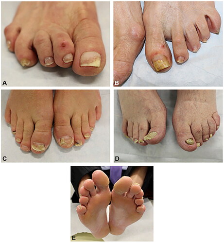 Figure 6. Physical examination findings in onychomycosis. A, Right great toenail with subungual hyperkeratosis and nail plate onycholysis. B, Left great toenail with yellow discoloration and onycholysis. C, Multiple toenails with subungual hyperkeratosis and onycholysis. D, Toenails with severe onychodystrophy and ridging. E, Scale on the plantar feet and web spaces [Citation33].
