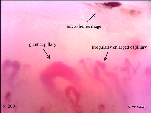 Figure 2. Representative photograph of irregularly enlarged capillary, giant capillary, and microhemorrhage.