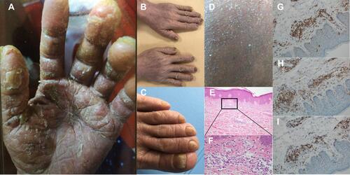 Figure 1 Representative images of skin manifestations and pathological examination of skin biopsy from the patient. (A) Keratoderma and fissures on her hands. (B and C). Nail thickening with color change on her hands (B) and feet (C). (D) Exfoliation on her back. (E–I) The skin biopsy shows non-specific dermatitis ((E) for original magnification × 40, (F) for original magnification × 400, (G–I) for original magnification × 200). (E and F) perivascular lymphocytes infiltration in the superficial dermis. (G) Positive staining for CD3. (H) Positive staining for CD4. (I) Positive staining for CD7.