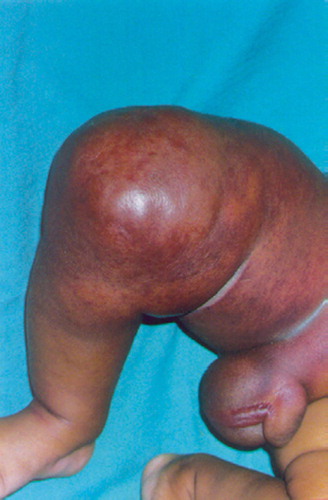 Figure 1. Right thigh swelling with penoscrotal edema