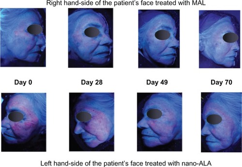 Figure 3 Sequence of images showing the time course of photodynamic therapy.