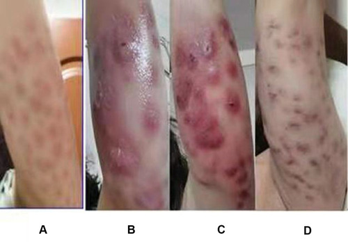 Figure 1 Evolution of skin in this patient. (A). Erythema and pain at the puncture site one day after the phosphatidylcholine solution administered at a beauty salon. (B) Lesions with purulent discharge. (C) Abscesses. (D) After one-year course of treatment, in May 2021, Resolution of the abscesses after one-year course of treatment with erythema still present.