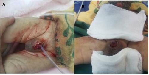 Figure 2 (A) Complete skin loss after ritual circumcision with severe bleeding. (B) The penile body after bleeding control.