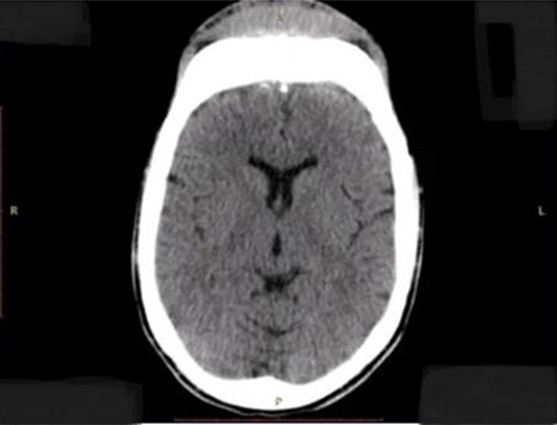 Figure 3 CT scan of the head showing the thickening of the overlying forehead soft tissue and increased paralleling bone lesions.