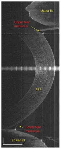 Figure 1 Upper and lower tear menisci, imaged with ultra-high-resolution optical coherence tomography.