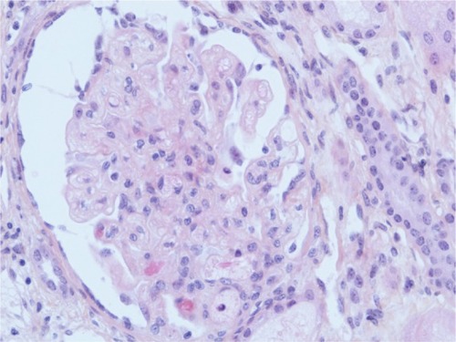 Figure 1 Acute glomerular lesion.