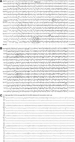 Figure 1 (A) First EEG pattern of the patient: atypical delta wave complexes on our patient’s EEG. Left postero-temporal focal lesion with polymorph delta waves (1 – shaded). (B) Second EEG pattern of the patient: alpha-basic rhythm with 8–9 cycles per second and with diffuse irritative changes, unmodified during eye opening, with asymmetric slow sharp wave discharges in the C-T region bilaterally (1 and 2 – shaded). (C) Normal EEG pattern for comparison: a basic activity with subalpha-theta waves, without pathological changes and asymmetry. (A and B) Registrations with time constant 0.10 s, high frequency filter 30.0 Hz, notch filter: yes, sensitivity: 5.0 µV/mm. (C) Registration with time constant 0.10 s, high pass filter 5.30 Hz, low pass filter 20.0 Hz, notch filter: yes.