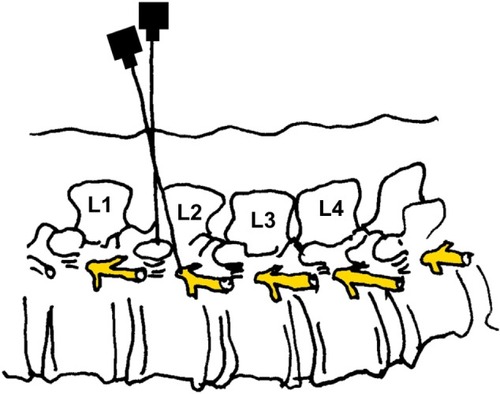 Figure 4 Paravertebral blockade (PVB): needle insertion, side view.