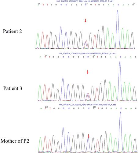 Figure 4 A heterozygous missense mutation, c.5183C>T (p.A1728V), was detected in exon 42 in patient 2 and the patient’s father patient 3.