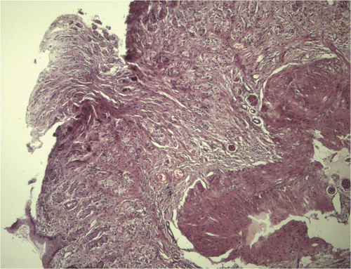 Figure 3. Microphotograph of gastric mucosa showing infiltration of lymphocytes and plasma cells in the lamina propia with intermingling fibrosis. (Haematoxylin-eosin, original magnification ×100).