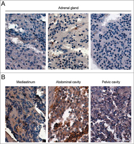 Figure 1. The expression level of HDAC6 in neuroblastoma tissue samples varies with the site of the tumor. Immunohistochemistry of HDAC6 expression in neuroblastoma from adrenal glands (A) and 3 other sites (B), including mediastinum, abdominal cavity, and pelvic cavity. Scale bars, 10 μm.