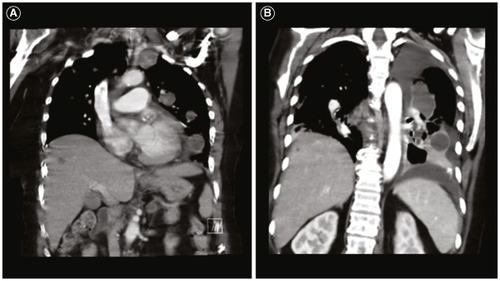 Figure 3. Patient's metastatic glioblastoma to the lungs. (A) Coronal computed tomography (CT) chest shows multiple enhancing pulmonary metastases. (B) Coronal CT chest shows further progression of pulmonary metastases and new hepatic metastases.