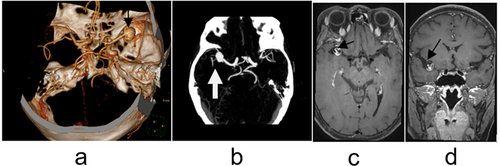 Figure 4 A 68-year-old female patient. (a–d) images of CTA VR, MIP, and HI-VWI respectively, can show the distal aneurysm of the M1 segment of the right middle cerebral artery, and the tumor wall is significantly strengthened after enhancement. In this case, the SR is 4.46. (a) is the VR image of CT and the black arrow shows the aneurysm distal to the M1 segment of the right middle cerebral artery; (b) is a CT maximal intensity projection image and the white arrow indicates the aneurysm distal to the M1 segment of the right middle cerebral artery; (c and d) are high-resolution MRI cross-sectional and coronal images, and the black arrows show the presence of enhancement in the aneurysm wall.