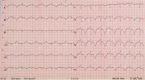 Fig. 1.  The electrocardiogram demonstrates the “characteristic” diffuse ST-segment and T wave inversion and QTc-prolongation in this case of severe organophosphate poisoning. These electrocardiographic changes were present in this patient as early as 6 hours up to 6 days after admission, regardless of the treatment.