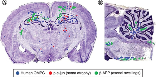 Figure 2. Distribution of intranasally delivered olfactory mucosa progenitor cells to axonal damage and cell atrophy.Mapping of OMPC cells and p-c-jun+ and β-APP+ profiles in a coronal (A) and parasagittal section (B) OMPCs were found in injury sites. Injured regions include the cerebral cortex, cerebellum, cerebral peduncles and brain stem tracts. Some of the dots do not appear perfectly circular because of the overlap of dots. In most brains, the number of human OMPCs on each side differed by less than 11%. In this illustrated section, there is more than 11% difference in the number of OMPCs between the two sides and higher indicators of damage (β-APP and p-c-jun) on the side with more OMPCs. A limitation of this study is that labeled cells were not photographed using a confocal microscope to visualize processes of the OMPCs.OMPC: Olfactory mucosa progenitor cell.