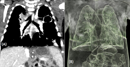 Figure 2 (A) Coronal plane images of chest CT scan demonstrating an extra bronchus origin above the carina, (B) Pulmonary 3D images demonstrating extra bronchus arising from the right lateral aspect of the trachea almost at the level of the carina.