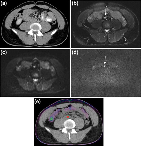 Figure 3. A 29-year-old man with testicular cancer. Axial CT image showed no pathologically enlarged lymph node at the time of diagnosis (a). T2-BLADE image showed a small lymph node measuring approximately 7 mm on short-axis diameter (arrow) (b). The lymph node showed a high signal intensity (restricted diffusion) on DW images (arrow); b50 (c) and b1000 (d). The lesion showed an intensive tracer upptake (SUVmax = 13.5) on 18F-FDG PET/CT two months later (e).