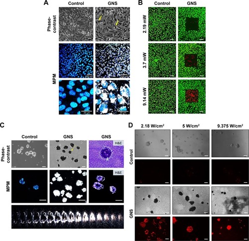 Figure 7 GNS uptake and photothermal ablation in drug-resistant IBC cell line rSUM149. (A) The drug-resistant IBC variant, rSUM149, was incubated with 0.15 nM GNS for 24 hours, stained with Hoechst 33342 and imaged by MPM. The GNS in the cells appear as black particles as observed by phase-contrast imaging (yellow arrows), whereas the GNS in the cytoplasm appear as white luminiscence under MPM. (B) Photothermolysis of rSUM149 cell line. Cells were incubated with 0.15 nM GNS for 24 hours and then exposed to a multiphoton pulsed laser for 3 minutes at various laser intensities. Following laser exposure, cells were stained with fluorescein diacetate (live = green) and propidium iodide (dead = red) to determine relative cell viability. The control samples (cells without GNS, ie, unlabeled) displayed full viability following photothermal treatment (scale bars =100 μm). (C) GNS penetrate rSUM149 tumor emboli. Tumor emboli shown here are imaged after 96 hours of embolic maturation. The control groups represent cells that are free of nanoparticle. For GNS-labeled emboli, nanoparticles were added after 96 hours of embolic maturation. Following 24 hours of GNS incubation, samples were stained with Hoechst 3342 and imaged with MPM. The black portions, shown by yellow arrows, represent GNS as observed by phase-contrast microscopy, whereas white luminescence represents GNS as observed by MPM (scale bars =100 μm). A 2D projection of the GNS-labeled tumor emboli is shown where individual Z slices of the stacked composite image are displayed. This projection demonstrates the depth of GNS penetrance into the tumor emboli. H&E staining displays the cross-sectional area of the emboli; MPM imaging of the cross-section further demonstrates the depth of GNS penetrance into the tumor embolic core. (D) Photothermal treatment of rSUM149 tumor emboli. Following GNS incubation, samples were exposed to an 808 nm continuous laser at various laser intensities. After treatment, the experimental samples were stained with propidium iodide to illustrate any cellular death that occurred following laser irradiation. All emboli that were incubated with GNS exhibited cell death following laser exposure. Control samples were treated with the same level of irradiation, which demonstrated virtually no cell death. Representative phase-contrast images of each sample are shown following treatment. Empty spaces seen under phase-contrast imaging for GNS-labeled emboli are due to the repositioning of the emboli following photothermal treatment. The GNS-labeled emboli appear in black color under phase-contrast imaging due to GNS uptake, compared to the unlabeled controls (scale bars =100 μm).Abbreviations: GNS, gold nanostars; H&E, hematoxylin and eosin; MPM, multiphoton microscopy.