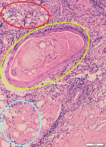 Figure 3 Histopathological findings with HE-staining revealed perivascular (red circle), periadnexal (yellow circle), and periadiposal (blue circle) lymphocytic, plasmacytic, and eosinophilic infiltration.