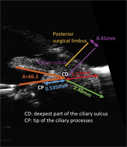 Figure 1 Anatomical measurements and landmarks based on UBM imaging. A (angle of the ciliary sulcus) = 66.3 degrees, the distance from CD to CP = 0.535mm, the length of a perpendicular line drawn from CD to the sclera = 1.52mm, and the length of a line drawn parallel to the posterior iris surface from CD to the sclera = 2.48mm.