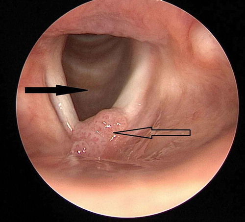 Figure 1. Endoscopic view of larynx. Solid arrow: trachea with normal mucosa. Hollow arrow: papillomatosis in the anterior commissure of the vocal cords