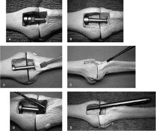 Figure 2. A. Reopening of osteotomy of the original anterior bony window. B. Removal of the locking nut. C. Direction of anterior sloping extension of anterior window osteotomy in the tibia to allow extraction. D. Use of a high-speed power metal cutting disc to cut the nail at the appropriate angle. E. Extraction of the distal tibial portion after telescoping into femoral canal and then angling out.