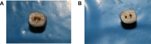 Figure 1 Teeth with TEC (A) and TREC (B) designs.