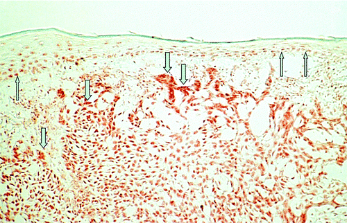 Figure 1. Immunohistochemical analysis of vitamin D receptor (VDR) expression in a basal cell carcinoma (BCC). Please note strong nuclear staining that is increased in tumor cells (↓) as compared with unaffected overlying epidermis (↑) of human skin (labeled streptavidin-biotin technique using mAb 9A7γ).