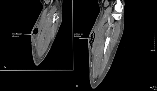 Figure 2. CT scan of the left leg (sagittal scans): evidence of large subfascial abscess (a) and multiple air bubbles in the sub- and supra-fascial soft tissues (b).