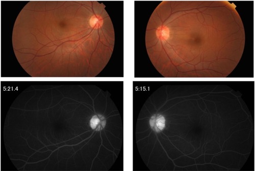 Figure 2 Fundus photograph (upper) and fluorescein angiogram (lower) at the time of relapsing scleritis in Case 1.