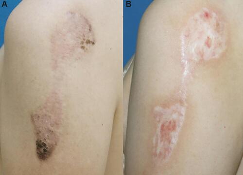 Figure 4 A patient with multiple lesions of keloids on her shoulder prior to treatment (A) and 1 year after PSR treatment with 2 radiation therapy thereafter (B). No recurrence was found.