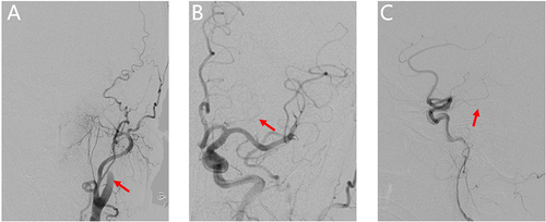 Figure 1 Features of the emergency digital subtraction angiography (DSA). (A) DSA suggests occlusion of the left internal carotid artery. (B and C) Occlusion of the distal segment of the left anterior choroidal artery (indicated by arrows).