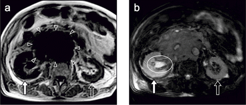 Figure 2. (A) T1-weighted image shows an enlarged right kidney with loss of corticomedullary differentiation (closed-white arrow) and a normal-sized left kidney with preserved corticomedullary differentiation (open-white arrow). A retroperitoneal tumor is depicted adjacent to the right kidney as a low intensity area (arrowheads). (B) T2-weighted image shows that the right kidney (closed-white arrow) has significantly higher signal intensity than the left kidney (open-white arrow), and the right renal pelvis (circle) is enlarged with high signal intensity.