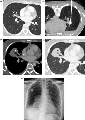 Figure 4. Bronchopleural fistula developed after lung radiofrequency ablation in a 34-year-old woman with an intrapulmonary metastasis from ovarian cancer. (a) Chest CT obtained before RFA demonstrates the tumor (arrow) in the right middle lobe. (b) There is an electrode placement through the tumor under CBCT guidance. (c, d) Computed tomography image obtained 51 days after ablation shows collection of fluid and air (arrowhead) in the right major fissure and adjacent bronchus (arrow), suggesting the possibility of bronchopleural fistula. (e) Plain chest radiograph obtained 82 days after ablation shows large pneumothorax. The bronchopleural fistula was closed after surgical repair.