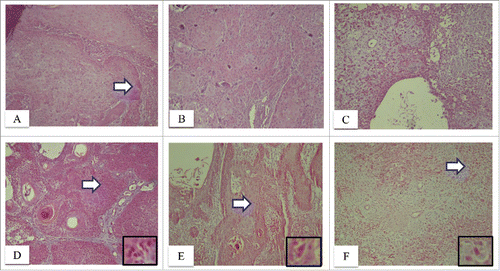 Figure 1. Immunolocalization of ADAM10, ADAM17 in cutaneous squamous cell carcinomas. Note the increased cytoplasmic immunoreactivity of ADAM10 in well differentiated CSCC. Note that ADAM10 immunoreactivity is increased in the peripheral margin of tumor islands in well differentiated CSCC as compared to the central portion of tumor islands (arrow) (A, x100). Note the increased ADAM10 immunoreactivity in the cytoplasm of moderately differentiated CSCC tumor islands (B, x100). Note that ADAM10 immunoreactivity is increased in the cytoplasm of poorly differentiated CSCC (C, x100). Note the increased cytoplasmic and nuclear immunoreactivity of ADAM17 in well differentiated CSCC (D, ×100). The arrow highlights the area magnified in the inset (D, x400). Note the increased cytoplasmic and nuclear ADAM17 immunoreactivity in the cells of moderately differentiated CSCC (E, x100). The arrow highlights the area magnified in the inset (E, x400). Note that ADAM17 immunoreactivity is increased in the nucleus and cytoplasm of poorly differentiated CSCC (F, x100). The arrow highlights the area magnified in the inset (F, x400).