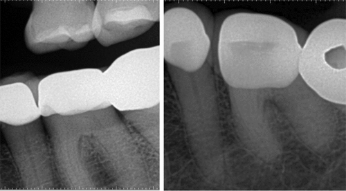 Figure 2. Note calcified chamber of #19. Difficult case to access.