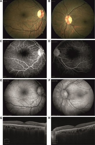 Figure 4 Four months after presentation, BCVA was 20/20 in both eyes.