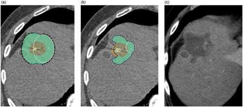 Figure 3. Comparison of the predicted (a), simulated (b), and achieved ablation volume (c), adjacent to an internal marker (cyst—dashed white outline). Manufacturer’s predicted ablation volume (a) can toggle to the Accublate simulation (b) intraprocedurally. CECT at same level 2 days after ablation (c). Accublate simulation volume is smaller than manufacturer’s prediction, and more closely describes the shape. (Volumes in a and b are displayed superimposed on the electrode; in c, the cyst provides an internal reference to identify the similar level.)