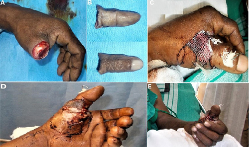 Figure 3 Thumb fingertip amputation beyond the Middle phalanx joint (A). Amputated finger (B). Reattached the finger using one vein repair and one vein graft (C). Postoperative finger appearance (D). 5th-week postoperative appearance (E).