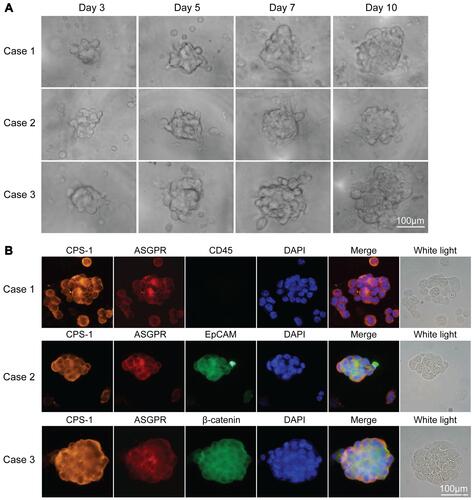 Figure 1 Culture and identification of CTC spheroids from the blood sample of patients with HCC. (A) Typical images of CTC spheroids from the blood samples of patients with HCC after different periods of culturing. (B) Identification of CTC spheroids from the blood samples of patients with HCC using immunofluorescence analysis.