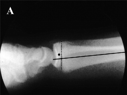 Figure A. Non-anatomic reduction of a dorsally displaced distal radial physeal injury in a 15-year-old boy (10% of dorsal displacement and 5% of dorsal angulation). B. Redisplacement in the cast (30% displacement and12% dorsal angulation), leaving a persistent malunion.