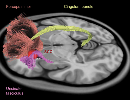 Figure 2. Tractography for subcallosal cingulate cortex (SCC) DBS. Effective SCC DBS involves concurrent stimulation of 4 white matter tracts: the forceps minor (red), the uncinate fasciculus (purple), the cingulum bundle (yellow), and the fronto-striatal fibres (not shown). These white matter tracts are used to guide lead placement for SCC DBS.