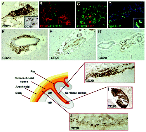 Figure 3. Meningeal inflammation in MS. Immunostainings of MS brain sections show intrameningeal ectopic B-cell follicle like structures in a cerebral sulcus containing CD20+ B cells (A), ramified stromal cells/FCD expressing CD35 (inset A) and expressing CXCLI3 (B), Ki67+ proliferating B cells (C), and plasmablast/plasma cells stained with an anti- Ig-G, -A, -M polyclonal antibody (D; the inset shows two intrafollicular plasma cells at high magnification). CD20+ B cells are also present in periventricular WM lesions (E) and in scarcely inflamed meninges entering a cerebral sulcus in a SPMS (F) and PPMS case (G). The lower schematic picture illustrates the localization of ectopic B-cell follicle like structures in the MS brain. These follicle like structures are present along (H) and in the depth (I) of the cerebral sulci, whereas scattered B lymphocytes (J) are detected in the meninges covering the external brain surface. Original magnifications: E-G = 100x; A, D, H-J = 200x, B, C and insets in A and D = 400x. Reproduced from Magliozzi et al.Citation59 with permission from Oxford University Press.