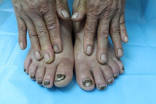 Figure 1 Clinical photograph showing diffusely blackish pigmentation on all toenails at the first visit.