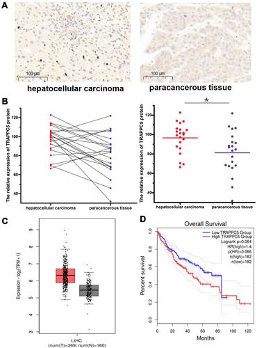 Figure 2 TRAPPC5 is overexpressed in HCC tissue microarrays and indicated poor prognosis. (A, B) TRAPPC5 is overexpressed in HCC tissue microarrays (n=21). TRAPPC5 protein was detected in cancer tissues in higher levels, whereas paracancerous tissues expressed much lower. Scale bars, 100 μm (magnification, 100×). (C) TRAPPC5 is highly expressed in HCC tissues (n=369) compared with that in normal tissues (n=160) using the GEPIA database. (D) Kaplan-Meier analysis of overall survival showed that patients with overexpression of TRAPPC5 have a poor prognosis (n=182) using the GEPIA database. *P < 0.05.